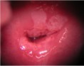 /album/fotogaleria-colposcopia/lesion-por-virus-del-papiloma-humano-jpg/